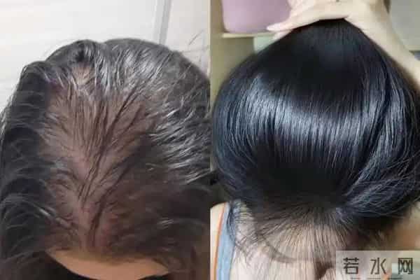 30+掉发快秃了？医生教的5个习惯+内调，发缝慢慢变窄