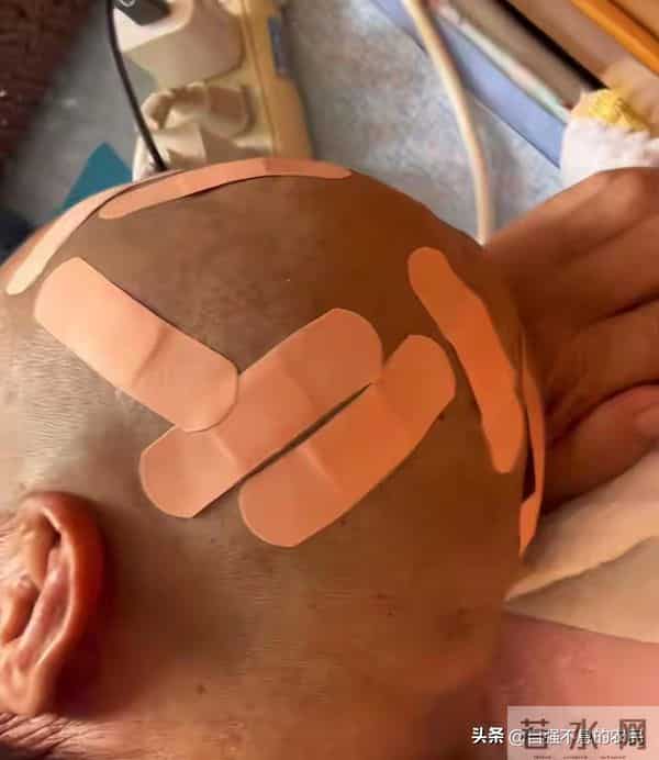 大爷花10元剃头后满头伤口不忍追责