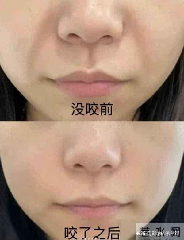 对法令纹最快的招！咬筷子 21 天，淡到卡不住粉，亲测不花冤枉钱