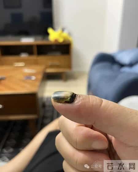 网友记录手指甲掉落的全过程