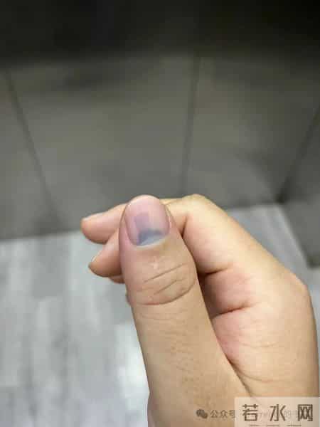 网友记录手指甲掉落的全过程