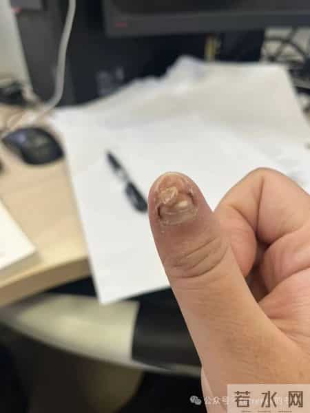 网友记录手指甲掉落的全过程