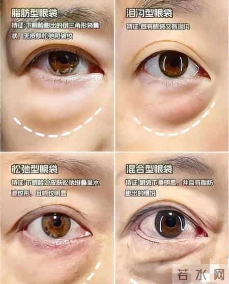 针对眼袋重的女生:不用医美,坚持做眼袋慢慢变平