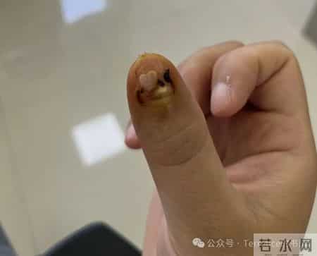 网友记录手指甲掉落的全过程