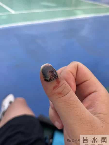 网友记录手指甲掉落的全过程