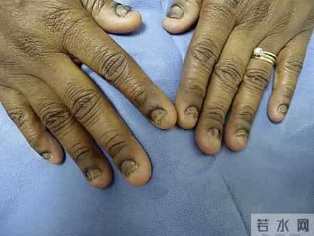 不建议你一过年就爱美甲的原因是:可能会影响补牙!