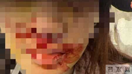 演员金晨被曝“肇事逃逸让助理顶包”，警方刚刚通报！本人回应，公布受伤照片