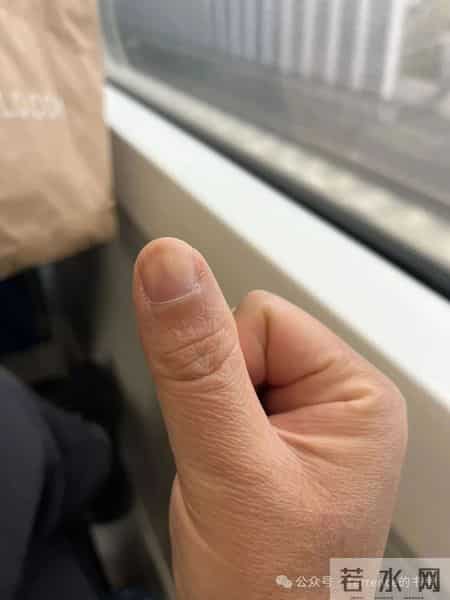 网友记录手指甲掉落的全过程