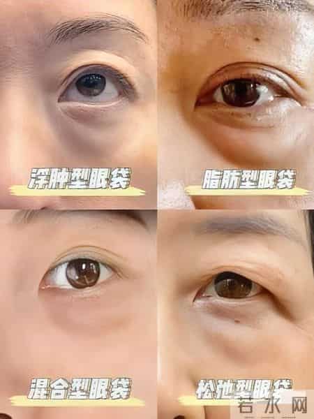 针对眼袋重的女生:不用医美,坚持做眼袋慢慢变平