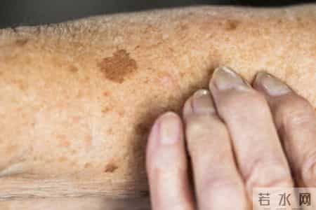 老年斑不只是衰老的“锅”，4个隐形推手要警惕