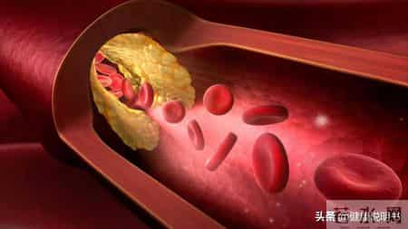 医生研究得出：大量喝茶的高血脂患者，不用多久，身体或有5变化