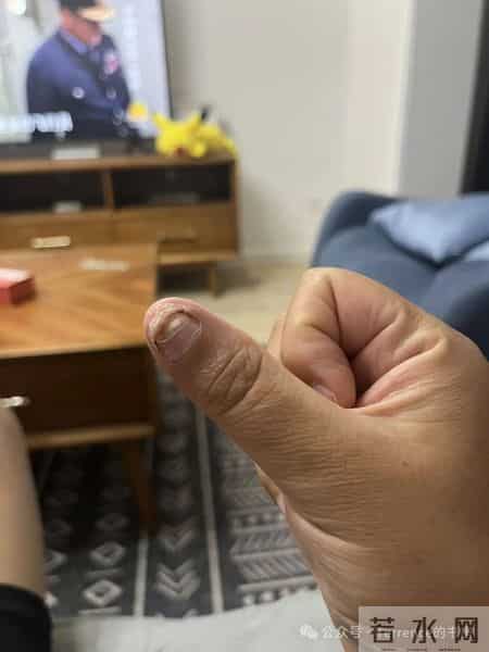网友记录手指甲掉落的全过程