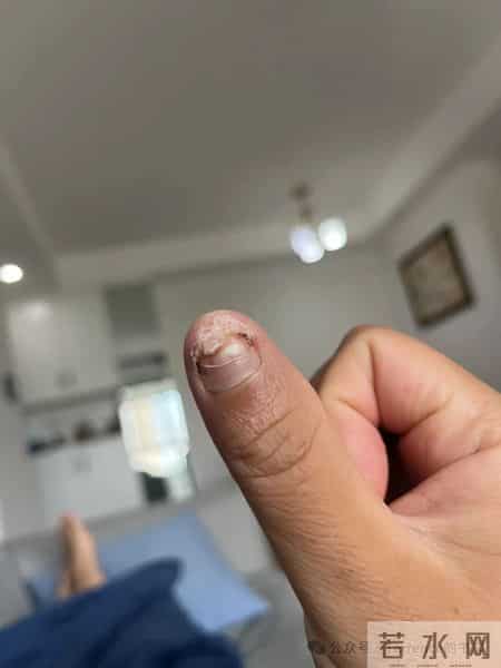 网友记录手指甲掉落的全过程