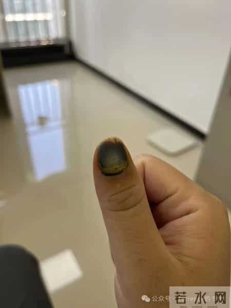 网友记录手指甲掉落的全过程