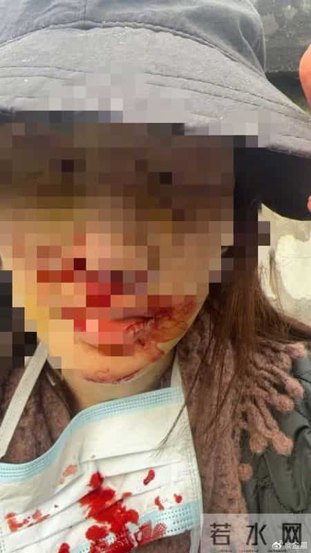 演员金晨被曝“肇事逃逸让助理顶包”，警方刚刚通报！本人回应，公布受伤照片