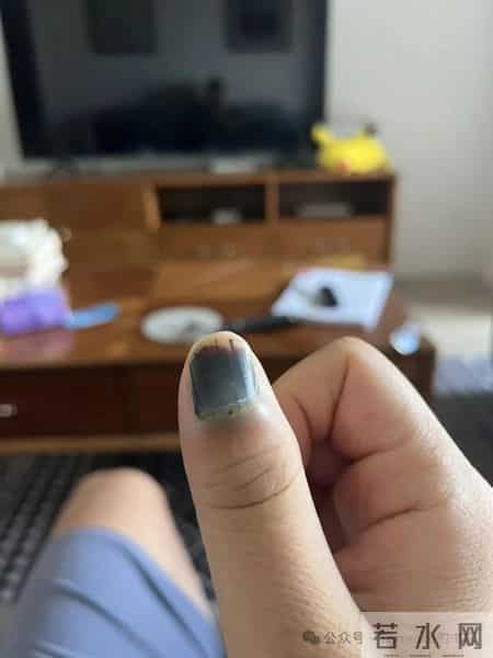 网友记录手指甲掉落的全过程