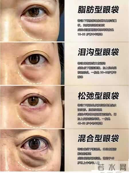 针对眼袋重的女生:不用医美,坚持做眼袋慢慢变平