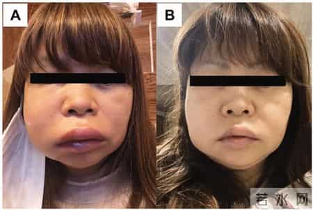 不建议你一过年就爱美甲的原因是:可能会影响补牙!