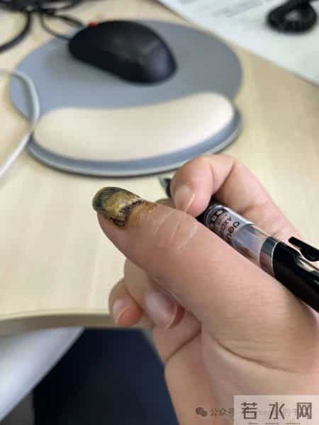网友记录手指甲掉落的全过程