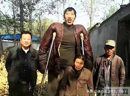 一个身高2米4的山东汉子走了，才35岁！他被身高拖垮的一生