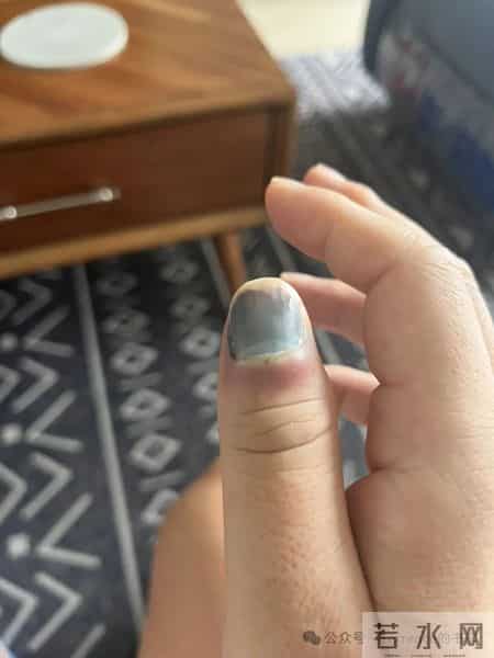 网友记录手指甲掉落的全过程