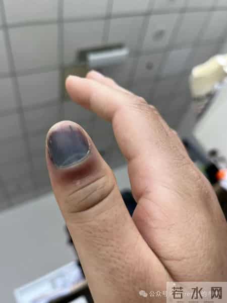 网友记录手指甲掉落的全过程