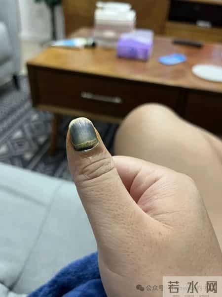 网友记录手指甲掉落的全过程