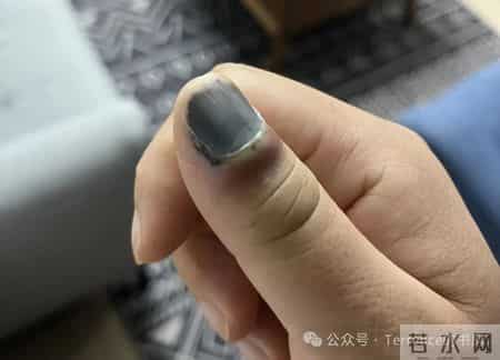网友记录手指甲掉落的全过程