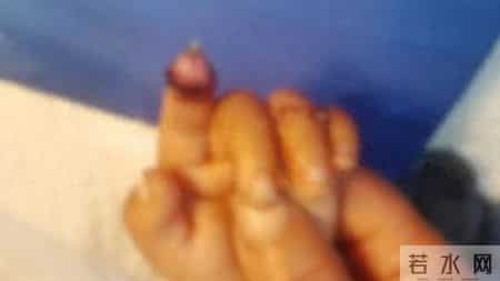 河南1岁男童喂兔子时手指被咬断,情急之下将兔子开堂破肚取断指